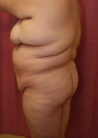 Brazilian Butt lift for plus size woman before 993828