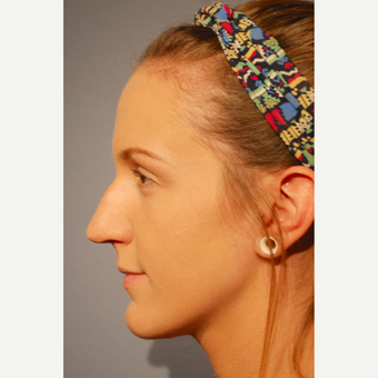18-24 year old woman treated with Rhinoplasty before 3417499