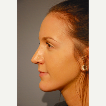 18-24 year old woman treated with Rhinoplasty after 3417499