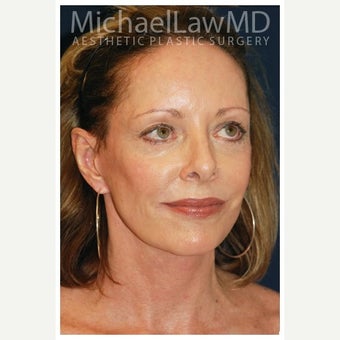 55-64 year old woman treated with Cheek Lift after 1550721