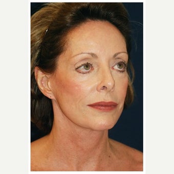 55-64 year old woman treated with Cheek Lift before 1550721