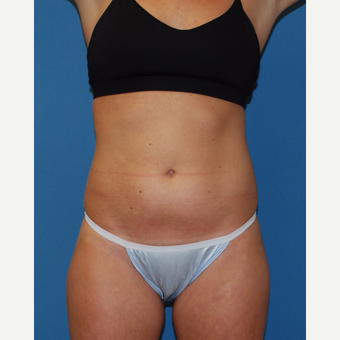 25-34 year old woman treated with SculpSure before 3413503