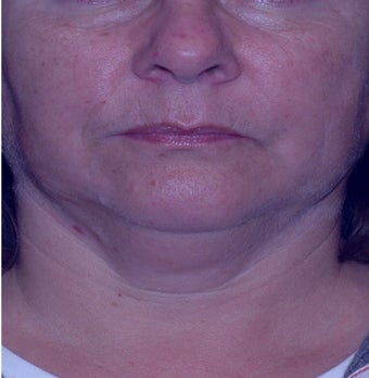 Double chin gone with liposuction alone before 3330613