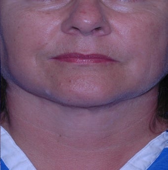 Double chin gone with liposuction alone after 3330613