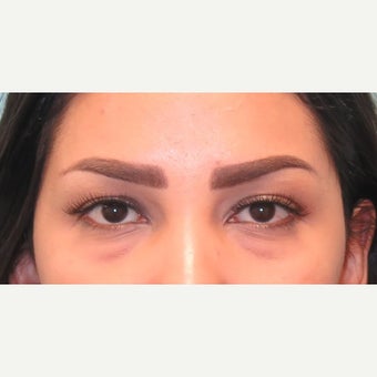 25-34 year old woman treated with lower lid blepharoplasty. before 2438467