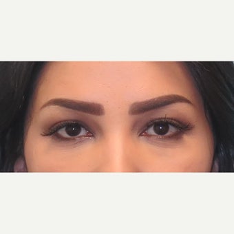 25-34 year old woman treated with lower lid blepharoplasty. after 2438467