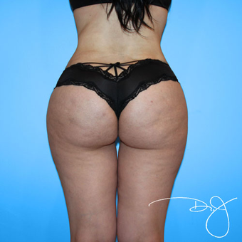 Brazilian Butt Lift and Buttock Augmentation after 3038213