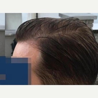 35 year old man treated with FUE Hair Transplant 1975319