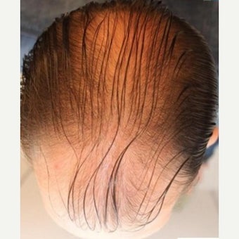 35 year old man treated with FUE Hair Transplant before 1975319