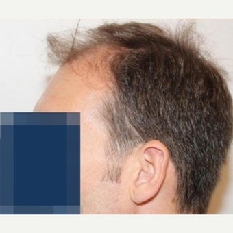 35 year old man treated with FUE Hair Transplant 1975319