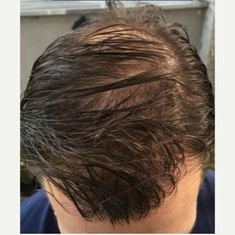 35 year old man treated with FUE Hair Transplant after 1975319
