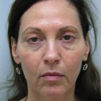 45-54 year old woman treated with Injectable Fillers before 3137158