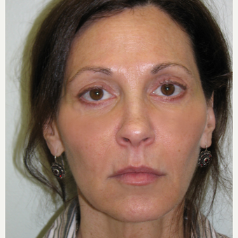 45-54 year old woman treated with Injectable Fillers after 3137158
