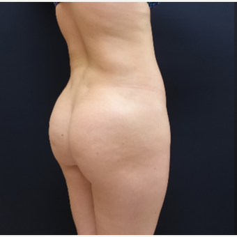 25-34 year old woman treated with 712cc Round Silicone Butt Implants before 3259546
