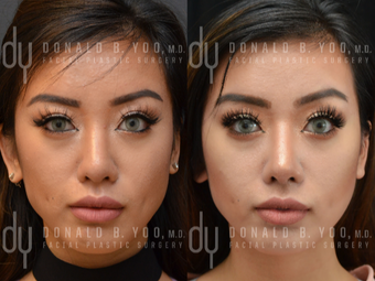 Asian Rhinoplasty with Rib cartilage before 3739398