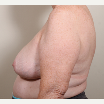 55-64 year old woman treated with Breast Reduction after 3398769