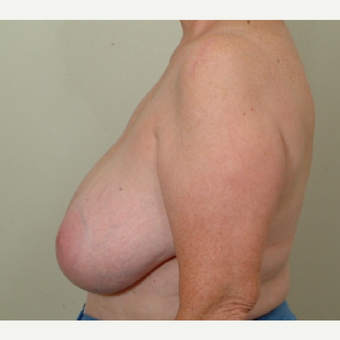 55-64 year old woman treated with Breast Reduction before 3398769