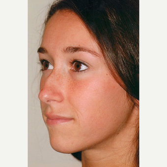 18-24 year old woman treated with Rhinoplasty before 3406221