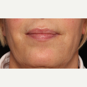 65-74 year old woman treated with Botox after 3520284