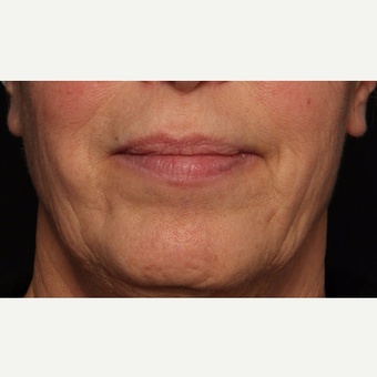 65-74 year old woman treated with Botox before 3520284