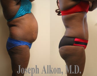 Tummy Tuck, Liposuction, and Fat Transfer to Buttocks (BBL) before 1199969