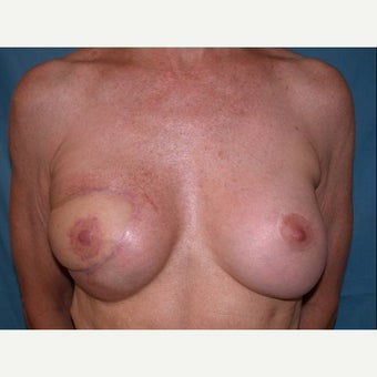55-64 year old woman treated with Breast Reconstruction after 1585113