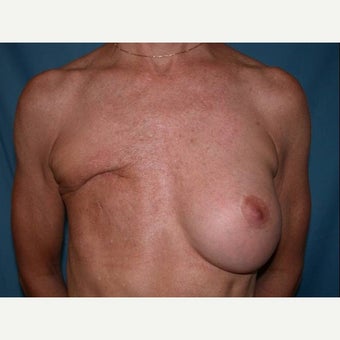 55-64 year old woman treated with Breast Reconstruction before 1585113