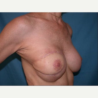 55-64 year old woman treated with Breast Reconstruction 1585113