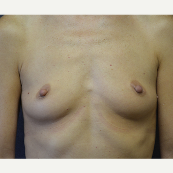 45-54 year old woman treated with Breast Implants before 3455411