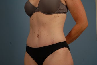 Abdominoplasty after 695831