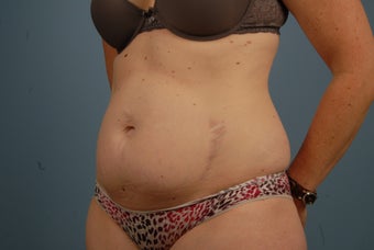 Abdominoplasty before 695831