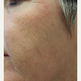 Fraxel for Rejuvenation after 1908873