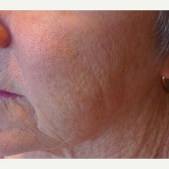 Fraxel for Rejuvenation before 1908873
