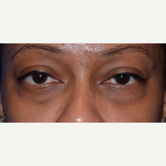 35-44 year old woman treated with lower blepharoplasty for eye bags. before 3398382