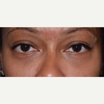 35-44 year old woman treated with lower blepharoplasty for eye bags. after 3398382