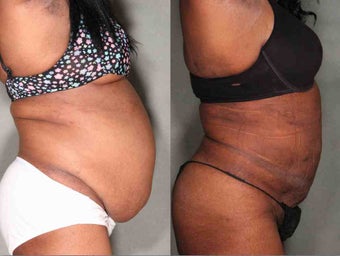 60 Year Old Female Unwanted Belly Fat before 1046323