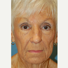 65-74 year old woman treated with Mohs Surgery after 3389161