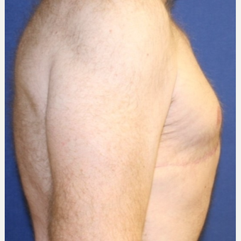 39 year old - Male Breast Reduction after 3065287