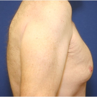 39 year old - Male Breast Reduction before 3065287
