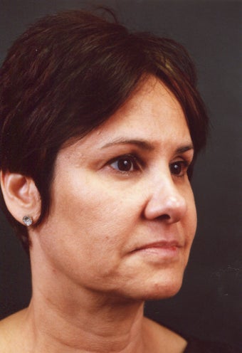 Two weeks after a dermal fat graft to both upper and lower lips. before 650191