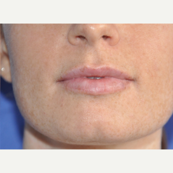25-34 year old woman treated with Lip Augmentation after 3219257