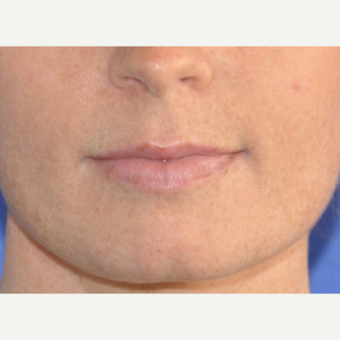 25-34 year old woman treated with Lip Augmentation before 3219257