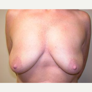 25-34 year old woman treated with Breast Augmentation before 3378469