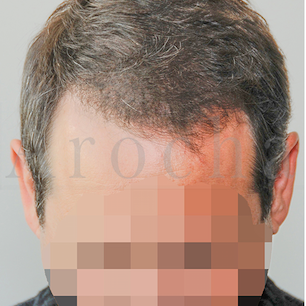 45-54 year old man treated with FUSS Hair Transplant after 3320364
