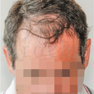 45-54 year old man treated with FUSS Hair Transplant before 3320364
