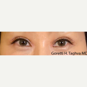 25-34 year old woman treated with Asian Upper Blepharoplasty and Medial Epicanthoplasty after 3611680