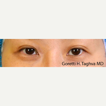 25-34 year old woman treated with Asian Upper Blepharoplasty and Medial Epicanthoplasty before 3611680