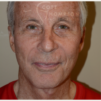 65-74 year old man treated with Facelift after 3321048