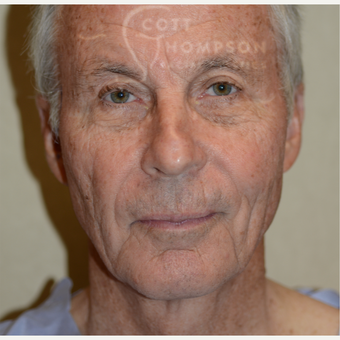 65-74 year old man treated with Facelift before 3321048