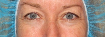 52 year old woman treated with Laser Resurfacing before 2842224